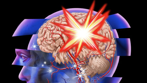How Can I Treat A Traumatic Brain Injury?